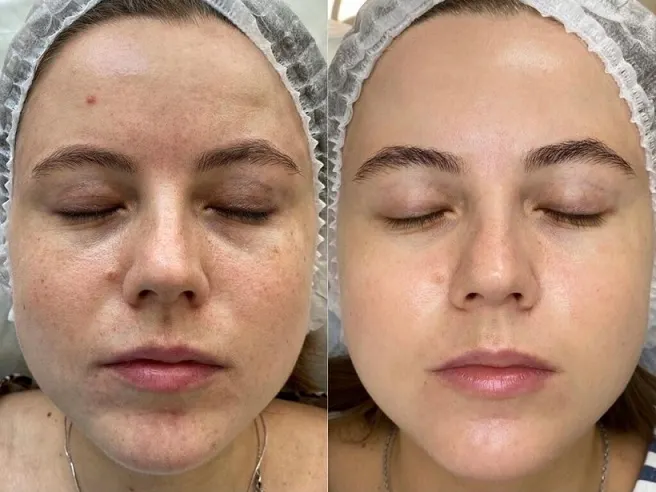 Biorevitalizing Peel